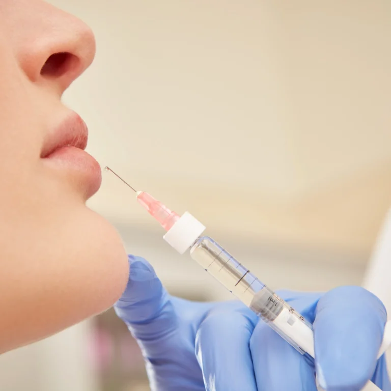 quanto dura il filler alle labbra